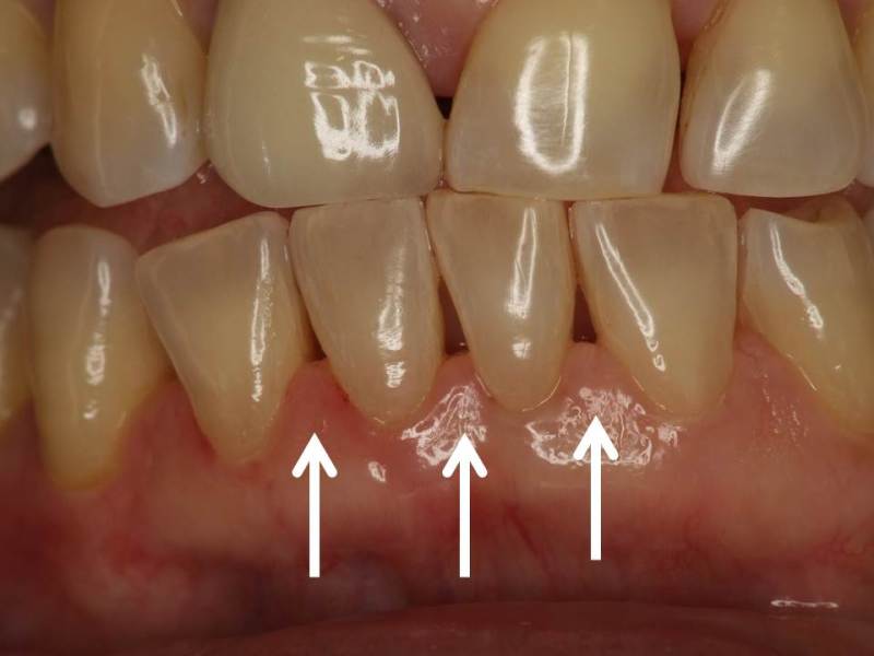 下顎前歯は歯石が付きやすい プラーク 歯垢 と歯石による歯茎の腫れ 神田の歯医者 神田デンタルケアクリニック