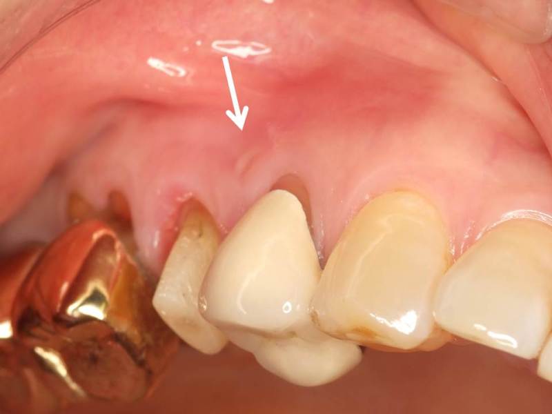 根尖病巣（こんせんびょうそう）による歯茎（歯肉）の腫れ  神田の 