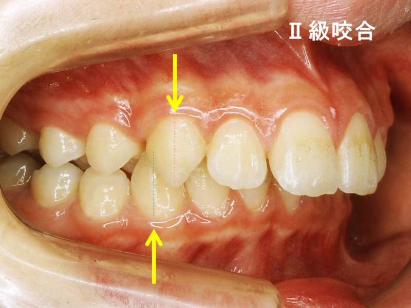 簡易的な不正咬合の見分け方 噛み合わせは 犬歯の位置関係が重要 2 神田の歯医者 神田デンタルケアクリニック