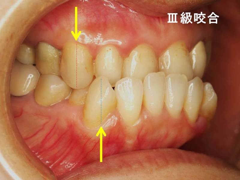 簡易的な不正咬合の見分け方 噛み合わせは 犬歯の位置関係が重要 3 神田の歯医者 神田デンタルケアクリニック