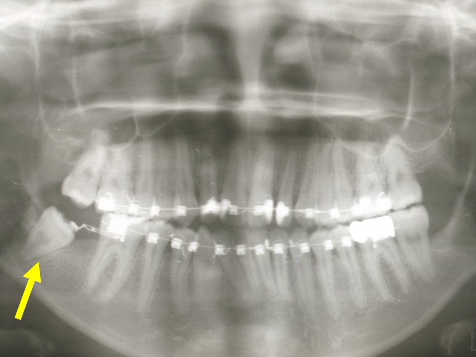 埋まっている親知らずを歯列矯正で引っ張る治療法 神田の歯医者 神田デンタルケアクリニック