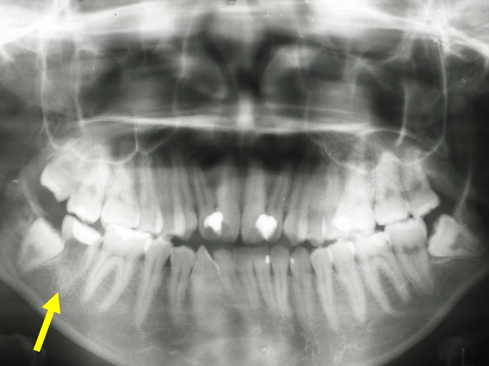 埋まっている親知らずを歯列矯正で引っ張る治療法 神田の歯医者 神田デンタルケアクリニック