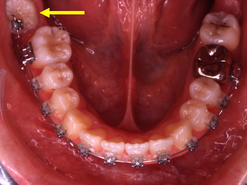 埋まっている親知らずを歯列矯正で引っ張る治療法 神田の歯医者 神田デンタルケアクリニック