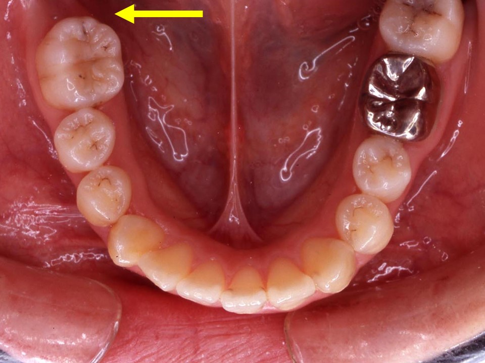 埋まっている親知らずを歯列矯正で引っ張る治療法 神田の歯医者 神田デンタルケアクリニック