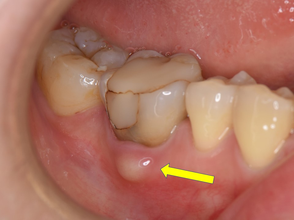 治療した歯の歯茎が腫れるのはなぜか？～根尖病巣による歯茎の腫れ～ - 神田の歯医者｜神田デンタルケアクリニック